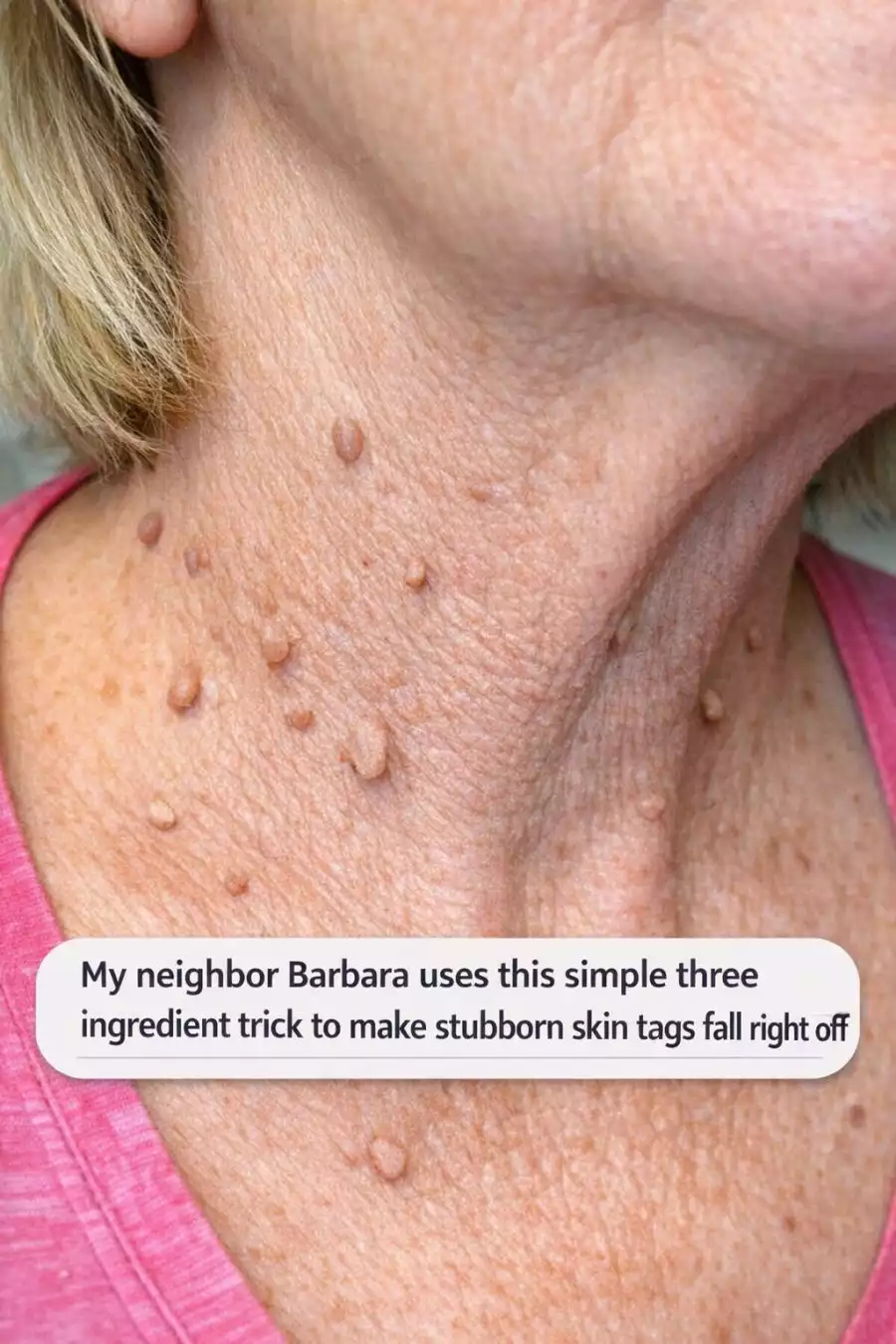 My neighbor Barbara uses this simple three ingredient trick to make stubborn skin tags fall right off